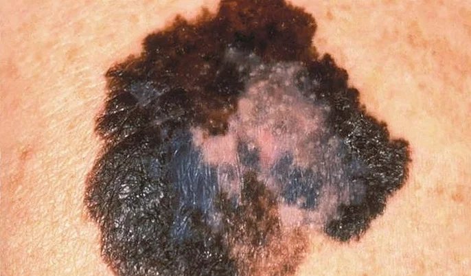 Melanoma: câncer de pele agressivo exige diagnóstico rápido para aumentar chances de cura - Imagem do artigo