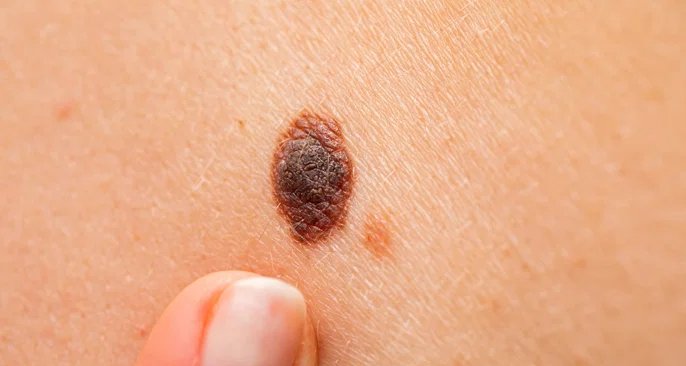 Melanoma nodular exige detecção precoce para aumentar chances de cura - Imagem do artigo