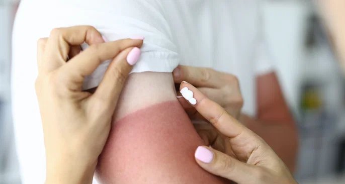 Pomadas mais indicadas para queimaduras leves: conheça opções e orientações de uso - Imagem do artigo