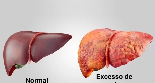 Gordura no fígado: cansaço, desconforto abdominal e outros sinais que podem indicar esteatose - Imagem do artigo