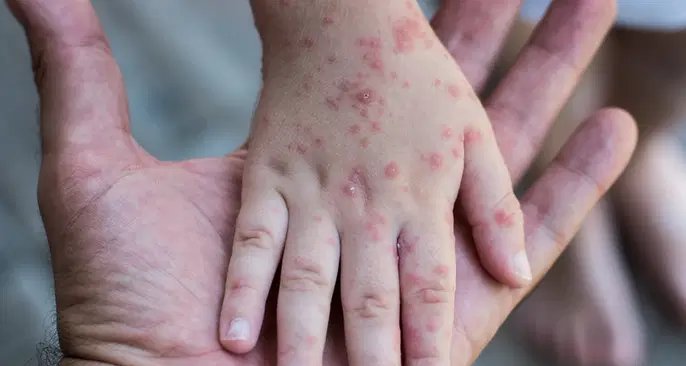 Rubéola: saiba reconhecer os principais sintomas e como confirmar a infecção - Imagem do artigo